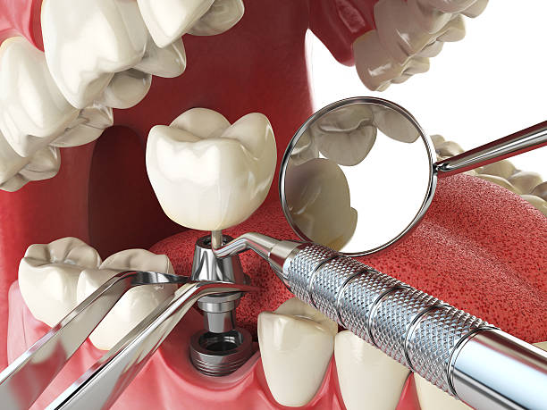 Best Emergency Tooth Extraction in Dade City, FL